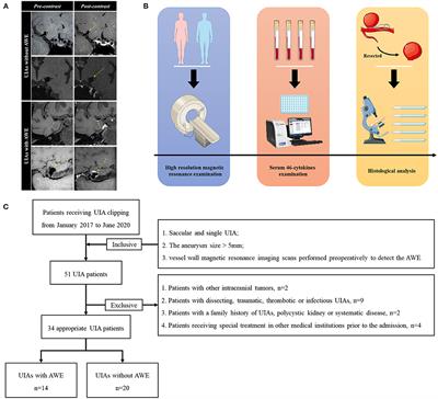 Serum IL-1, Pyroptosis and Intracranial Aneurysm Wall Enhancement: Analysis Integrating Radiology, Serum Cytokines and Histology